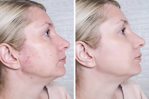Acne som Vuxen – Varför Det Händer och Hur Du Bekämpar Det