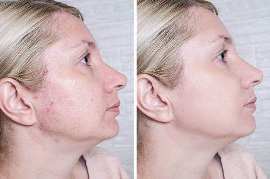 Acne som Vuxen – Varför Det Händer och Hur Du Bekämpar Det